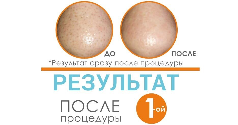 Результат после 1 процедуры Тыквенного пилинга DermaQuest - чистые и узкие поры